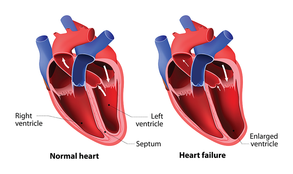 Low/Poor Heart Function